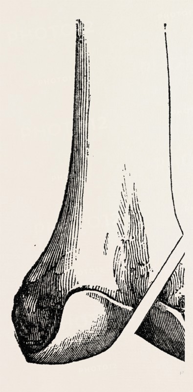 ogston's operation, medical equipment, surgical instrument, history of medicine