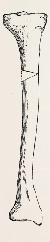 diagram representing a curved tibia, with a wedge removed, medical equipment, surgical instrument, history of medicine