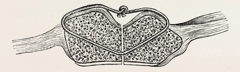 fragments in apposition, the wire knot hammered flat, medical equipment, surgical instrument, history of medicine