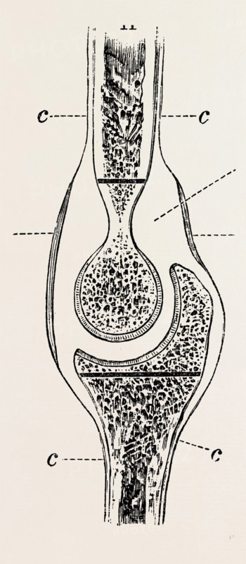 diagrams to illustrate the sub-periosteal method of resection, medical equipment, surgical instrument, history of medicine