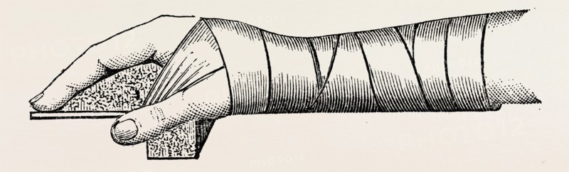 lister' s splint for excision, medical equipment, surgical instrument, history of medicine