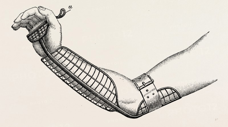 ollieris wire splint for excision of the wrist, medical equipment, surgical instrument, history of medicine