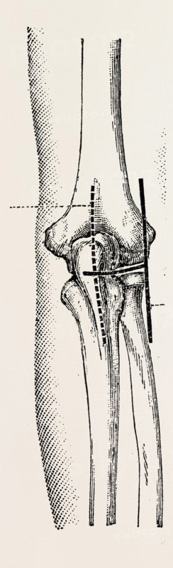 excision, medical equipment, surgical instrument, history of medicine