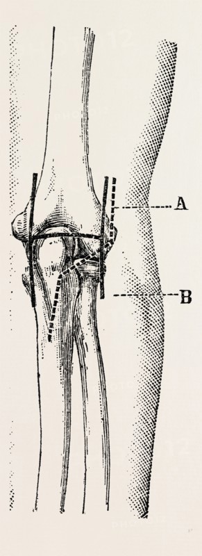 excision, medical equipment, surgical instrument, history of medicine