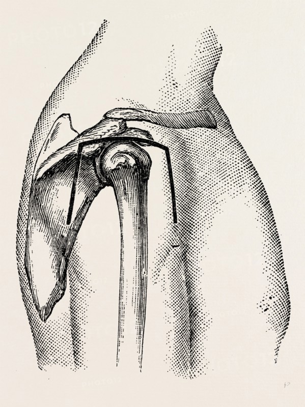 excision, medical equipment, surgical instrument, history of medicine
