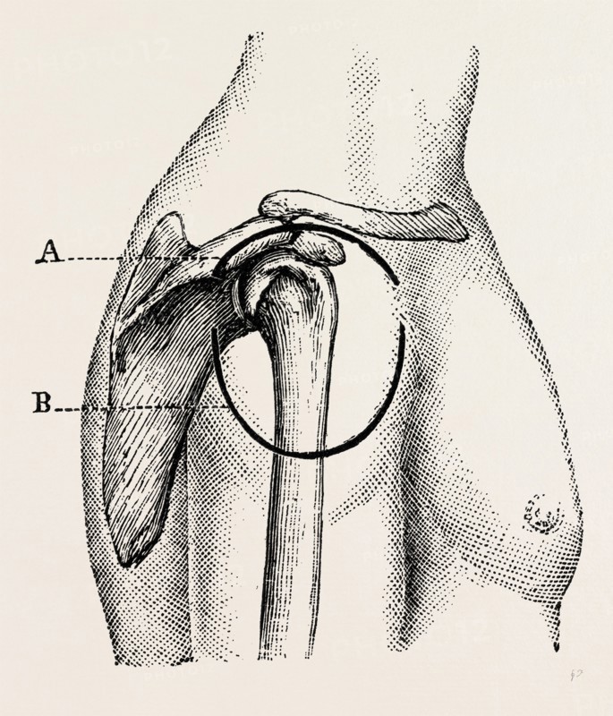 excision of the shoulder, medical equipment, surgical instrument, history of medicine