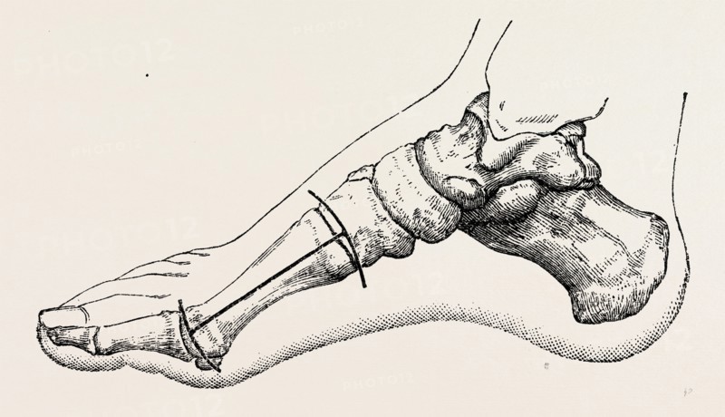 excision of first metatarsal bone, medical equipment, surgical instrument, history of medicine