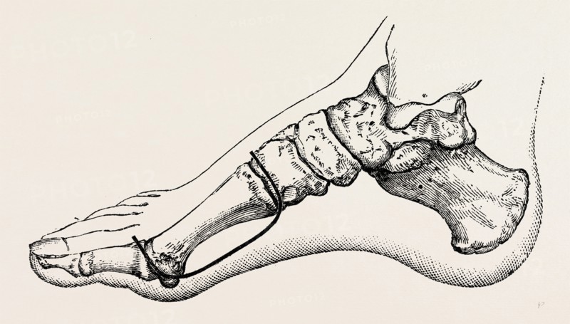 eicision of first metatarsal bone, flap, medical equipment, surgical instrument, history of medicine