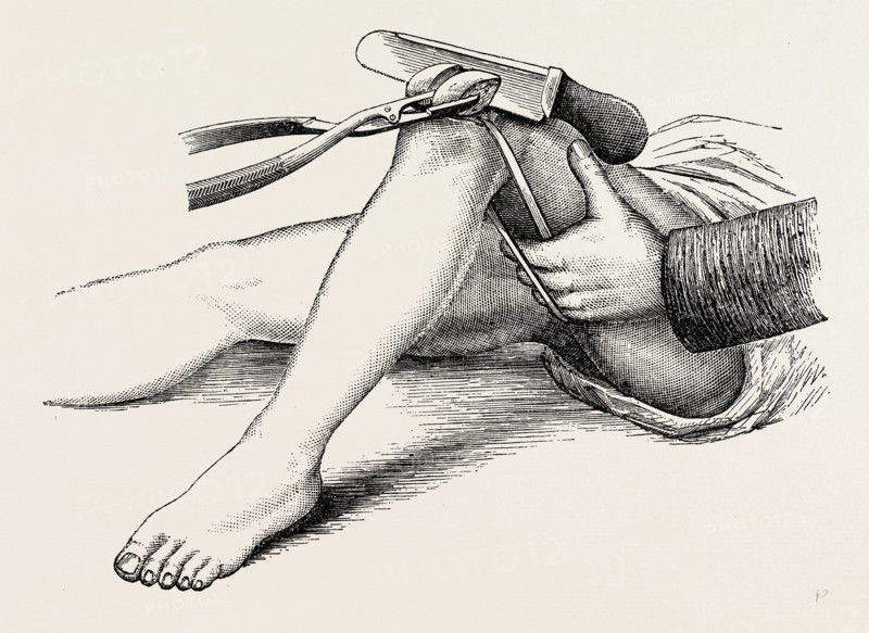 excision of the knee, the sawing of the lower end, medical equipment, surgical instrument, history of medicine