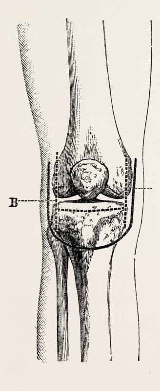 excision, medical equipment, surgical instrument, history of medicine