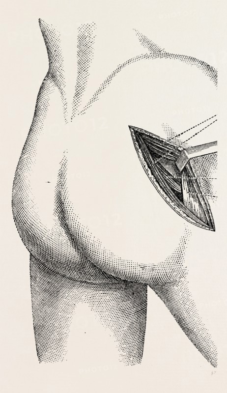 excision of the hip by an external incision, medical equipment, surgical instrument, history of medicine
