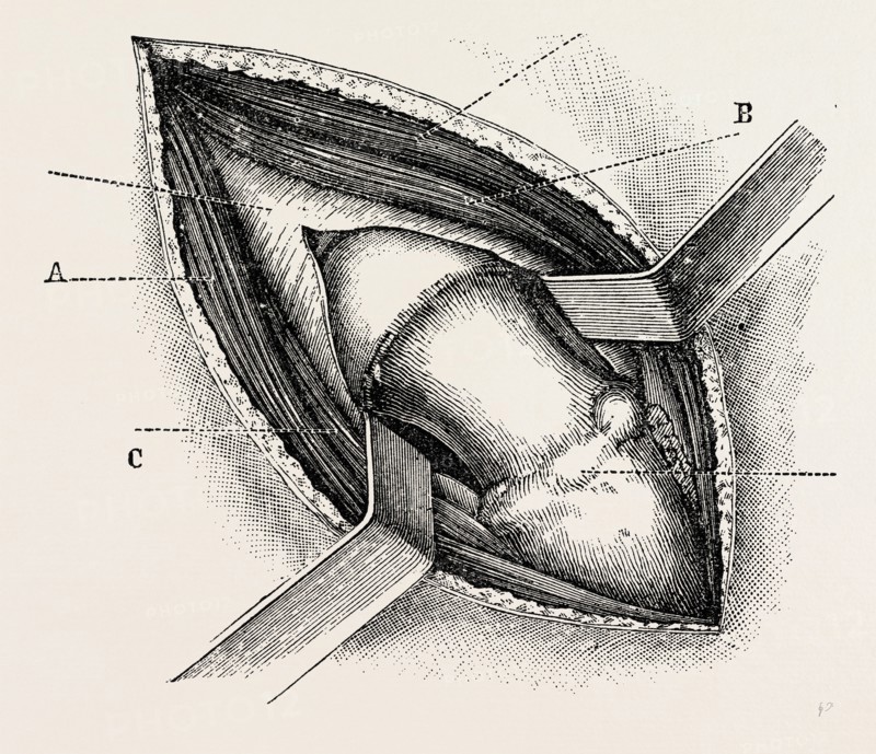excision of the hip by an external incision, medical equipment, surgical instrument, history of medicine