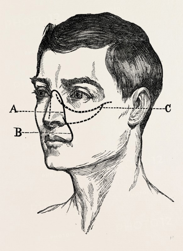 operations for naso-pharyngral, medical equipment, surgical instrument, history of medicine