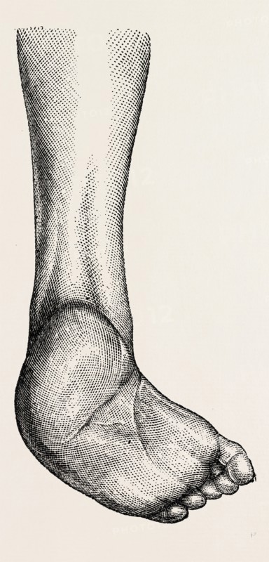 incurved form of the foot, the planzar, medical equipment, surgical instrument, history of medicine