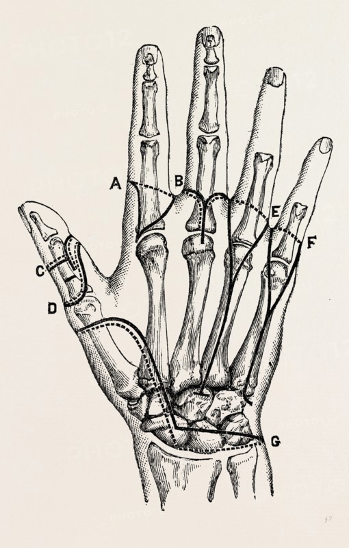disarticulation, medical equipment, surgical instrument, history of medicine