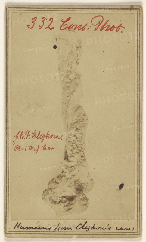 Necrosis of humerus removed Entire with elbow joint by James B. Cutter M.D. Newark, N.J. Patient John E.F. Cleghorn 1st N.J.Cav