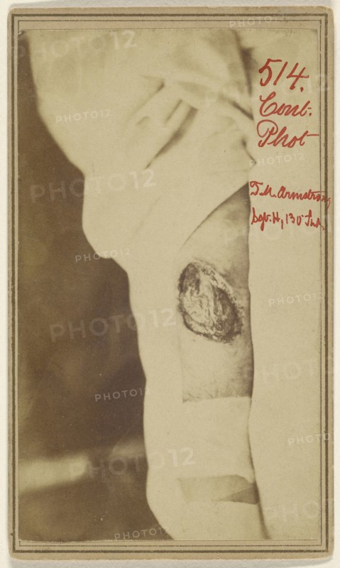 Leg wound of Thomas M. Armstrong, Civil War victim; American; November 2, 1864; Albumen silver print