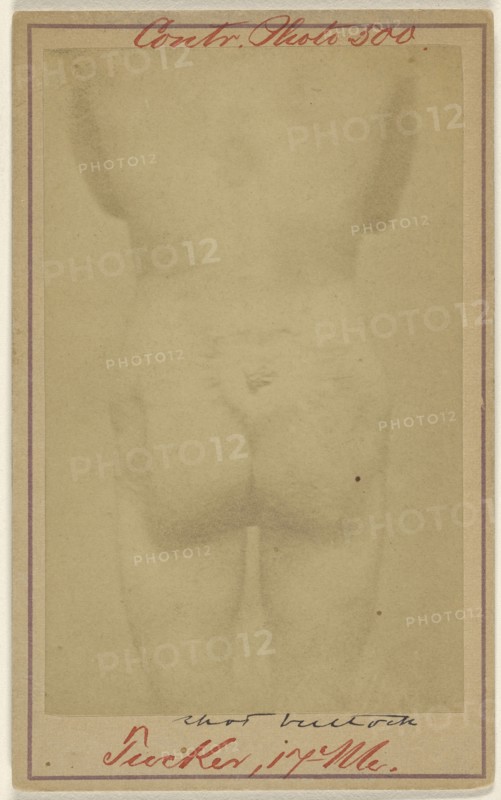 Jno. E. Tucker, shot in the buttocks, Civil War victim; American; 1865 - 1870; Albumen silver print