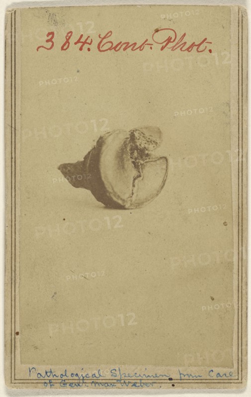 Pathological Specimen from case of Genl. Max Weber. Civil War victim; American; 1862 - 1864; Albumen silver print
