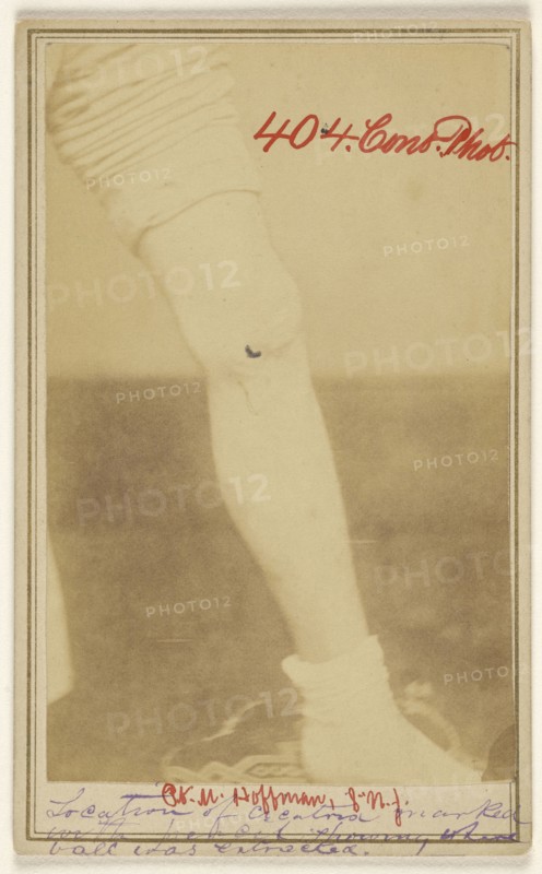M. Hoffman, Civil War victim; Dr. R.B. Brown, American, active Washington, D.C. 1860s, 1862 - 1864; Albumen silver print