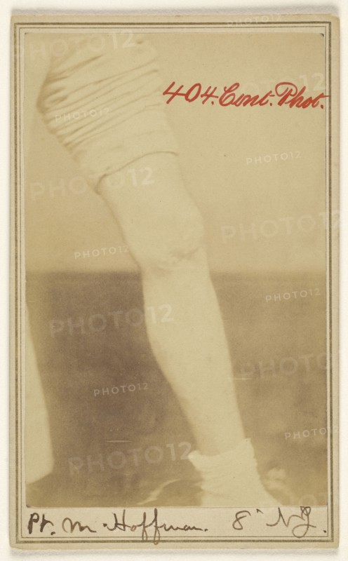 Pt. M. Hoffman, 8' N.J. Civil War victim; Dr. R.B. Brown, American, active Washington, D.C. 1860s, 1862 - 1864; Albumen silver