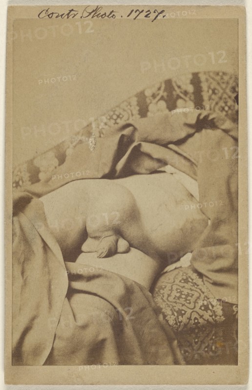 Diseased undescended Testes with Hydwelle; American; 1862 - 1872; Albumen silver print