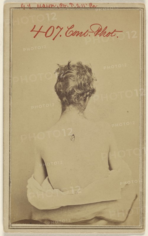 G.L. Mason, Pv. F. 211 Pa. Civil War victim; American; about 1865; Albumen silver print