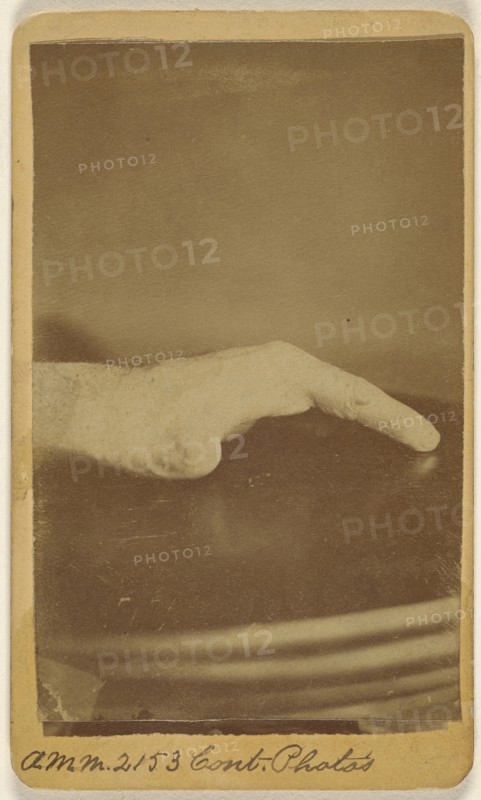 Right hand of Saml. Hagle, wounded at Petersburg June 17th 1864; H.D. Ward, American, active North Adams, Massachusetts 1860s