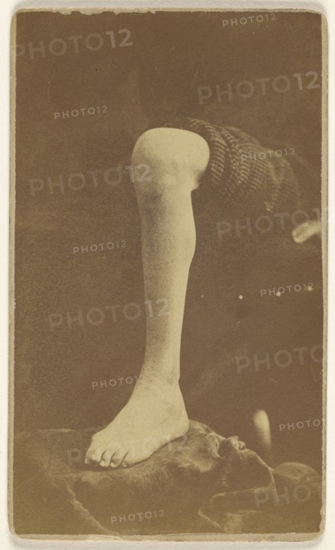 Excision ankle joint Pt. Robert Fuller 45th Ill. Post office Bedford Ohio Civil War victim; J. Dennison, American, active 1860s