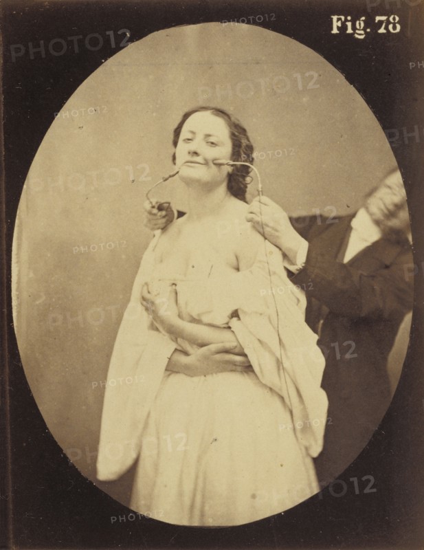 Electro-physiologie Photographique, Fig. 78; Guillaume-Benjamin Duchenne, French, 1806 - 1875, 1876; Albumen silver print