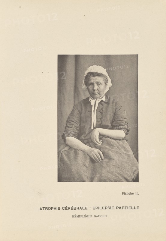 Atrophie Cérébrale: Épilepsie Partielle Hémiplégie Gauche; Paul-Marie-Léon Regnard, French, 1850 - 1927, Paris, France; 1878