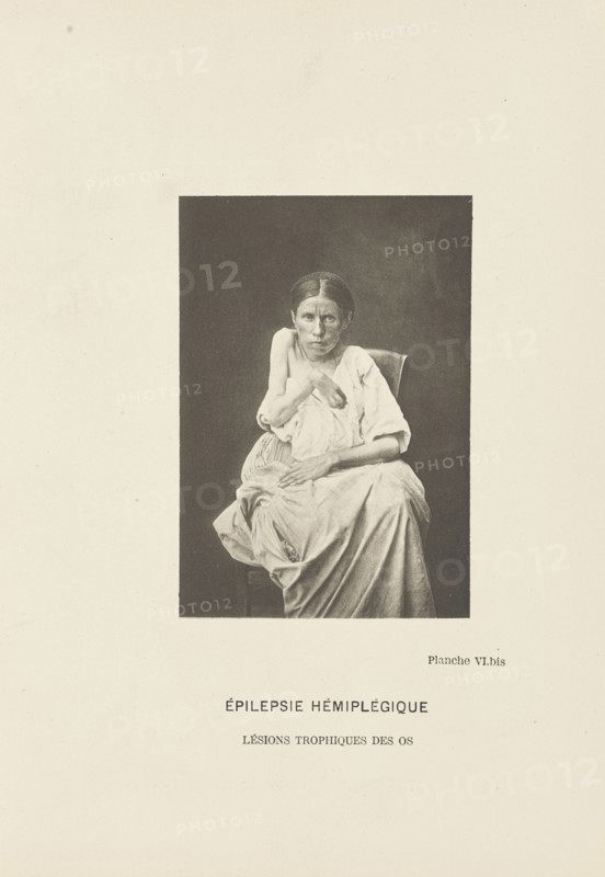 Épilepsie Hémiplégique Lésions Trophiques des Os; Paul-Marie-Léon Regnard, French, 1850 - 1927, Paris, France; 1878
