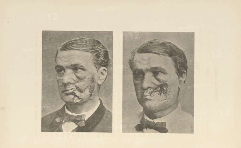 Restoration of Cheek; Charles B. Brigham, American, 1845 - 1903, Cambridge, Massachusetts, United States; 1876; Heliotype