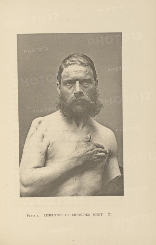 Resection of Shoulder Joint; Charles B. Brigham, American, 1845 - 1903, Cambridge, Massachusetts, United States; 1876