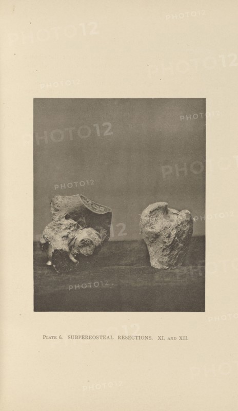 Subpereosteal Resections; Charles B. Brigham, American, 1845 - 1903, Cambridge, Massachusetts, United States; 1876; Heliotype