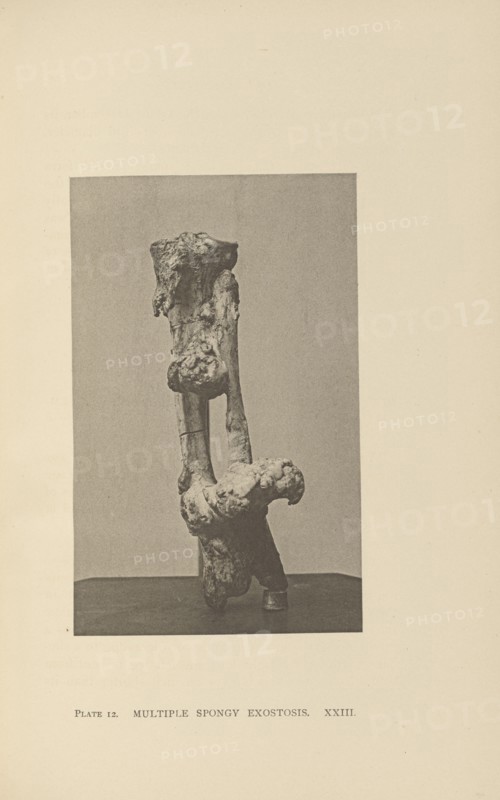 Multiple Spongy Exostosis; Charles B. Brigham, American, 1845 - 1903, Cambridge, Massachusetts, United States; 1876; Heliotype