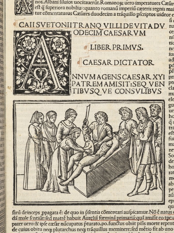 Detail of leaf, 5, recto with illustration depicting Julius Caesar's birth by caesarian section, Suetonius Tranquillus cum