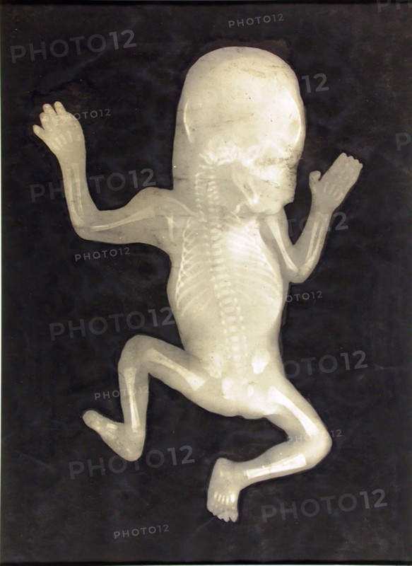 Degree of Ossification of a Five-Month-Old Fetus (Degré d’ossification d’un Foetus de cinq mois), 1898, French, 19th century, France, Gelatin silver print with applied india ink or watercolor, 31.5 × 23.3 cm (image/paper)