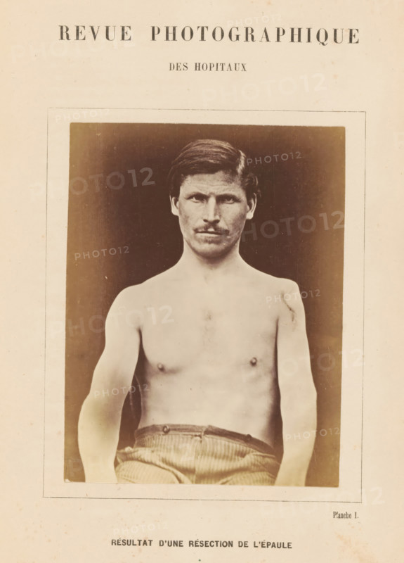 Result d'une résection de l'épaule, Portrait of an unknown man after a shoulder resection, photograph, page, inscription: 'Revue photographique, des hopitaux, Planche I.', c. 1865 - in or before 1870, photographer, paper, albumen print, height 127 mm x width 97 mm, historical persons, adult man, A sepia-toned photograph shows a shirtless man from the waist up, centered in a rectangular frame with a dark backdrop; he has short hair, a mustache, a neutral facial expression, visible shoulders and chest, and is wearing striped trousers at the waist with his arms relaxed at his sides.