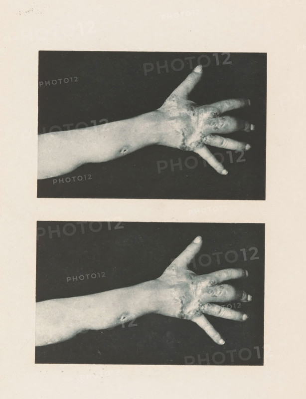 Two views of an arm with symptoms of skin lupus, page, photomechanical print, stereograph, photographer: Albert Ludwig Sigesmund Neisser, cliché maker: anonymous, c. 1884 - in or before 1894, paper, photoaquatint, height 175 mm x width 126 mm, lower arm, skin and venereal diseases, A grayscale image showing two rectangular photographs stacked vertically on a pale background, each containing an outstretched forearm and hand against a dark backdrop, the skin showing textured areas and irregular patches around the knuckles and back of the hand, fingers spread apart with visible fingernails, and a small round mark on the inner forearm.