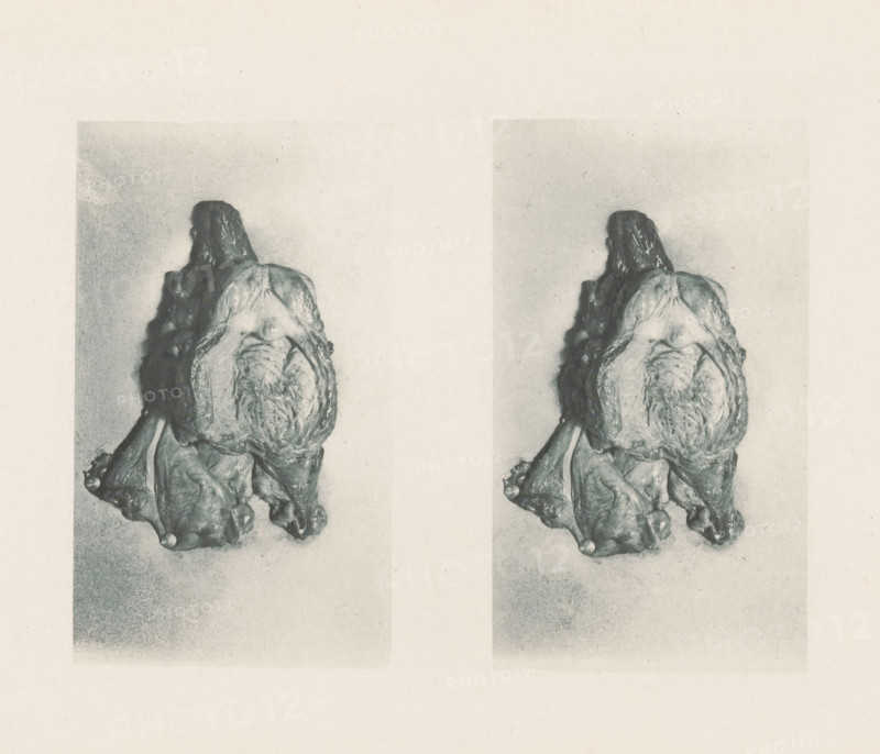 Two views of a prostate with hypertrophy of the lobes, page, photomechanical print, stereograph, photographer: Albert Ludwig Sigesmund Neisser, cliché maker: anonymous, c. 1884 - in or before 1894, paper, photoaquatint, height 126 mm x width 175 mm, diseases, male sexual organs, A faded monochrome print shows two vertically aligned, nearly identical images of an organic, irregularly shaped object with textured, layered surfaces and rounded protrusions, positioned against a pale, grainy background, each image framed by a subtle rectangular border.