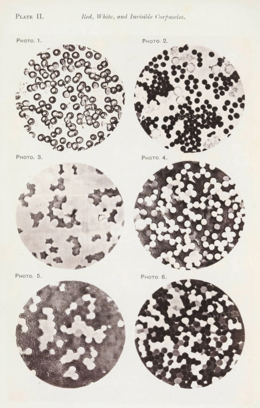 Six enlargements of blood cells, page, photomechanical print, number: 'Pl. II.', number: 'Photo. 1., Photo. 6.', photographer: Richard Norris, cliché maker: anonymous, c. 1872 - in or before 1882, paper, collotype, photoprint, height 213 mm x width 135 mm, Page opposite page 201., blood, A vertical page showing six circular microscope views arranged in two columns and three rows, each circle containing irregular dark and light shapes resembling clustered cells or particles against pale backgrounds; the top left circle shows ring-like dark outlines with pale centers, the top right contains many small solid dark round spots with a few pale rings, the middle left has scattered irregular dark blotches on a light ground, the middle right displays numerous pale round shapes over a darker mottled background, the bottom left shows larger pale rounded forms with dark surrounding areas, and the bottom right features densely packed dark round shapes interspersed with lighter areas.