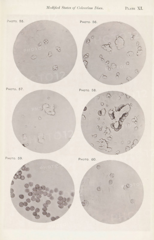 Six enlargements of colorless blood corpuscles, page, photomechanical print, number: 'Pl. XI.', number: 'Photo. 55., Photo. 60.', photographer: Richard Norris, cliché maker: anonymous, c. 1872 - in or before 1882, paper, collotype, photoprint, height 213 mm x width 135 mm, Page opposite page 210., blood, A vertical sheet showing six circular grayscale microscope views arranged in three rows and two columns, each circle containing various small pale shapes on a light background; the top left circle shows scattered irregular cloud-like outlines, the top right circle contains multiple small clustered and ringed forms with one larger irregular cluster, the middle left circle has a few faint rounded outlines and a small fuzzy cluster, the middle right circle displays a prominent irregular textured cluster surrounded by many small ringed shapes, the bottom left circle is filled with numerous round darker discs grouped toward one side, and the bottom right circle shows a few faint round outli...