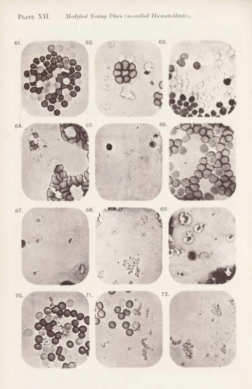 Twelve enlargements of blood corpuscles, page, photomechanical print, number: 'Photo. 61., Photo. 72.', number: 'Pl. XII.', photographer: Richard Norris, cliché maker: anonymous, c. 1872 - in or before 1882, paper, collotype, photoprint, height 213 mm x width 135 mm, Page opposite page 211., blood, A vertical sheet showing a grid of rounded square photographic panels arranged in columns and rows, each panel containing close-up circular and irregular cellular shapes in varying shades of gray, with some panels densely packed with dark outlined circular forms and others more sparse with scattered faint granules or clusters, a few panels display groupings forming ring-like patterns while others show loose aggregates or isolated darker spots, the overall background is a light beige with slight texture and the panels have a soft vignette around their edges.