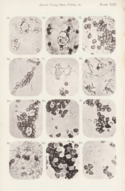 Twelve enlargements of blood corpuscles, page, photomechanical print, number: 'Pl. XIII.', number: 'Photo. 73., Photo. 84.', photographer: Richard Norris, cliché maker: anonymous, c. 1872 - in or before 1882, paper, collotype, photoprint, height 213 mm x width 135 mm, Page opposite page 213., blood, A vertically oriented page shows a grid of rounded-corner square photographic panels arranged in rows and columns, each panel containing close-up grayscale microscopic images of irregularly shaped cellular structures and fibrous material. The panels display clusters of small oval and circular forms with darker edges and lighter centers, some appearing grouped or overlapping, others dispersed singly; several panels contain branching, threadlike fibrous networks or starburst-like filamentous shapes against lighter backgrounds. The photographic frames exhibit varying contrast and grain, with some areas showing dense aggregations of dark, pebble-like elements and other areas showing sparse isol...