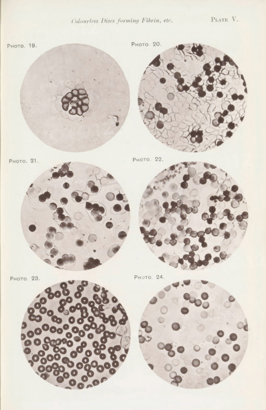 Six enlargements of blood cells, page, photomechanical print, number: 'Pl. V.', number: 'Photo. 19., Photo. 24.', photographer: Richard Norris, cliché maker: anonymous, c. 1872 - in or before 1882, paper, collotype, photoprint, height 213 mm x width 135 mm, Page opposite page 204., blood, A pale page shows a vertical arrangement of three pairs of circular microscope images, each circle containing clusters of round cells or disc-like forms in various densities and shades, with the top left circle featuring a central cluster of darker rounded shapes surrounded by a lighter background, the top right circle filled with many dark and light round elements overlapping irregularly, the middle left circle displaying scattered dark and faint round spots with some grouping, the middle right circle showing numerous round cells of varying darkness with some translucent areas, the bottom left circle densely packed with dark ringed discs against a light background, and the bottom right circle contain...