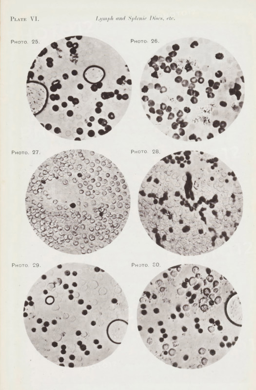 Six enlargements of blood cells and lymphocytes, page, photomechanical print, number: 'Pl. VI.', number: 'Photo. 25., Photo. 30.', photographer: Richard Norris, clichémaker: anonymous, c. 1872 - in or before 1882, paper, collotype, light print, height 213 mm x width 135 mm, Page opposite page 205., blood, A vertical page showing six circular grayscale microscopic images arranged in three rows, two columns, each circle containing various small round shapes and darker irregular spots; the top of the page has a small heading centered and a left-aligned plate label, and small labels beside each circular image; the circles display differing textures and densities of dots, rings, and clusters, with some circles containing larger dark rings or elongated dark areas, and the background of the page is a light off-white.