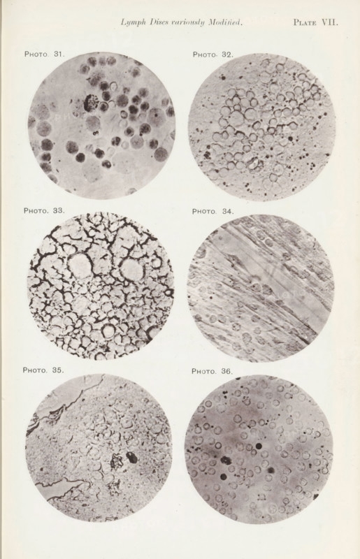Six enlargements of lymphocytes, page, photomechanical print, number: 'Pl. VII.', number: 'Photo. 31., Photo. 36.', photographer: Richard Norris, cliché maker: anonymous, c. 1872 - in or before 1882, paper, collotype, photoprint, height 213 mm x width 135 mm, Page opposite page 206., blood, A vertical page showing six circular grayscale microscope images arranged in two columns and three rows, each circle containing different textured patterns and clusters of rounded shapes; the top left circle shows various dark and light round spots of differing sizes on a mottled background, the top right circle displays many pale ringed circles densely packed toward the center with small speckles scattered around, the middle left circle contains a network of irregular dark lines forming enclosed rounded cells, the middle right circle shows diagonal striated bands overlaid with faint circular forms, the bottom left circle exhibits a coarse granular texture with uneven edges and scattered darker splo...