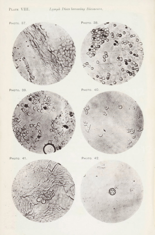 Six enlargements of lymphocytes, page, photomechanical print, number: 'Pl. VIII.', number: 'Photo. 37., Photo. 42.', photographer: Richard Norris, cliché maker: anonymous, c. 1872 - in or before 1882, paper, collotype, photoprint, height 213 mm x width 135 mm, Page opposite page 207., blood, Eight circular grayscale close-up images arranged in two vertical columns show varied textures and small round shapes. The top left circle contains fibrous streaks and clustered small rounded forms against a lighter background. The top right circle displays many small ringed discs scattered across the field with a dense cluster near the upper edge. The middle left circle shows numerous ringed discs concentrated toward the top and left edges with a darker circular outline near the bottom. The middle right circle has a few scattered ringed shapes and faint irregular marks on a mostly even background. The lower left circle reveals wrinkled, ridge-like textures with a small cluster of rounded forms nea...
