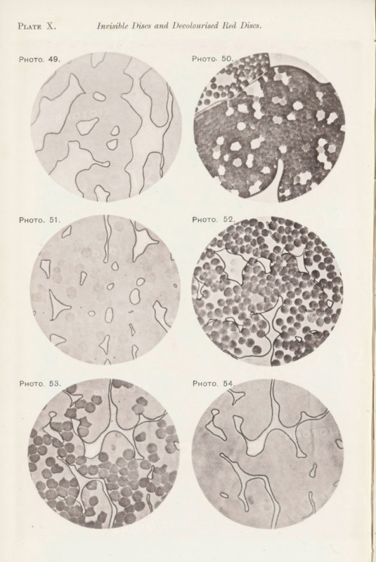 Six enlargements of blood after various procedures, page, photomechanical print, number: 'Pl. X.', number: 'Photo. 49., Photo. 54.', photographer: Richard Norris, clichémaker: anonymous, c. 1872 - in or before 1882, paper, collotype, light print, height 213 mm x width 135 mm, Page opposite page 209., blood, The image shows a vertical page with six circular grayscale illustrations arranged in three rows and two columns, each circle containing organic shapes and patterns; the top left circle has irregular outlined regions with light interior shading, the top right circle contains many small dark round spots clustered together with lighter irregular gaps, the middle left circle features faint rounded marks scattered with thin outlined shapes over a pale background, the middle right circle displays numerous densely packed dark circular elements interspersed with light irregular shapes and connecting lines, the bottom left circle shows clustered dark round forms along with pale curving part...